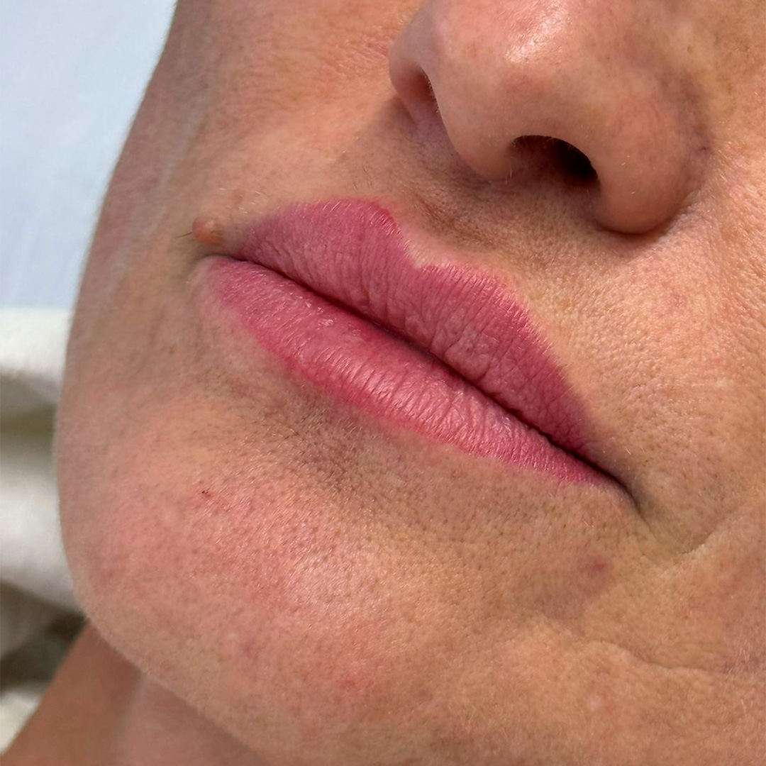 Boca antes de procedimento em clinica de estetica