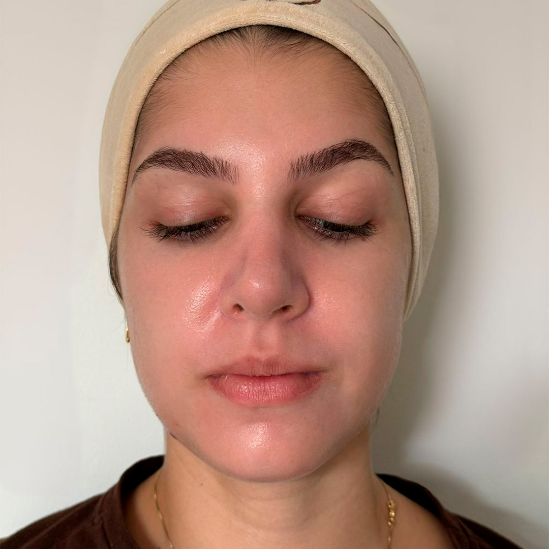 Mulher branca antes de procedimento facial em clinica de estetica