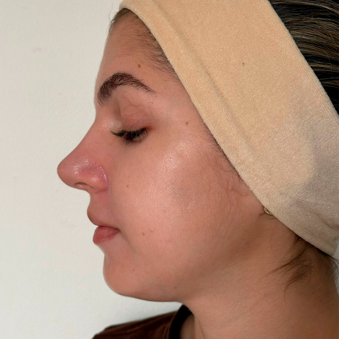 Mulher de perfil mostrando o nariz antes do procedimento em clinica de estetica