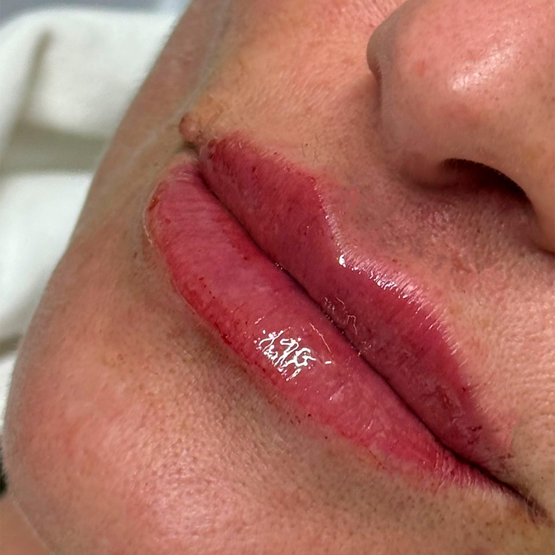 Boca depois de procedimento em clinica de estetica