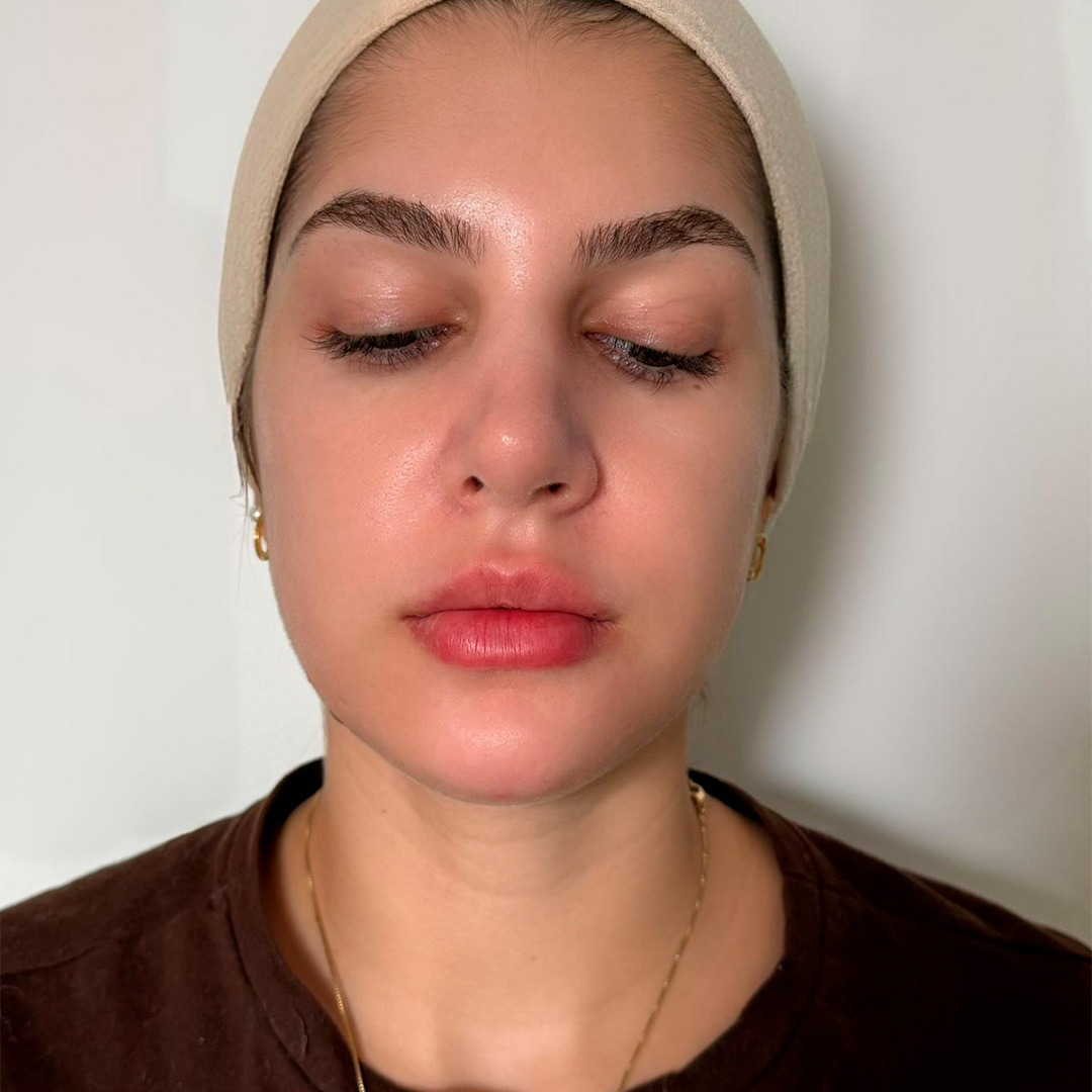 Mulher branca depois de procedimento facial em clinica de estetica