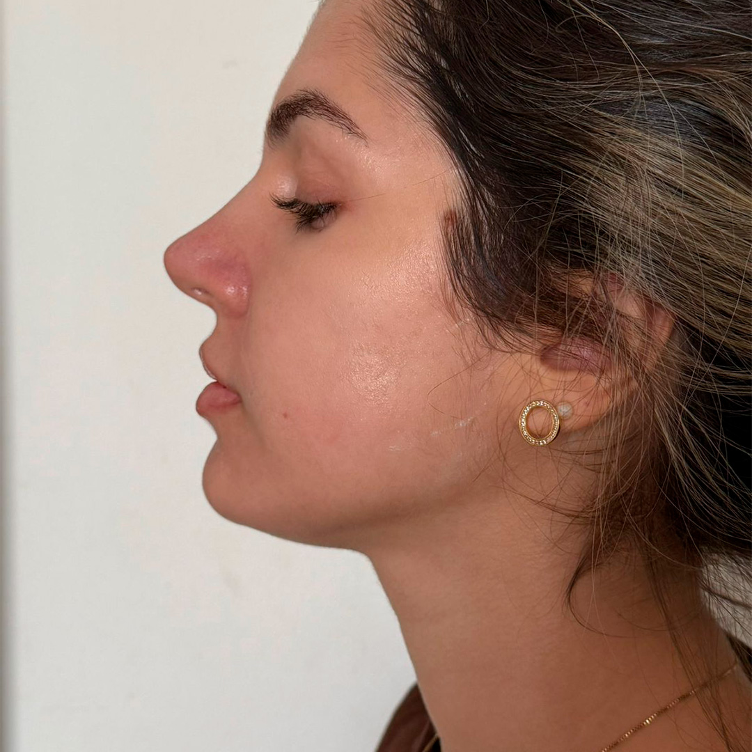 Mulher de perfil mostrando o nariz depois do procedimento em clinica de estetica