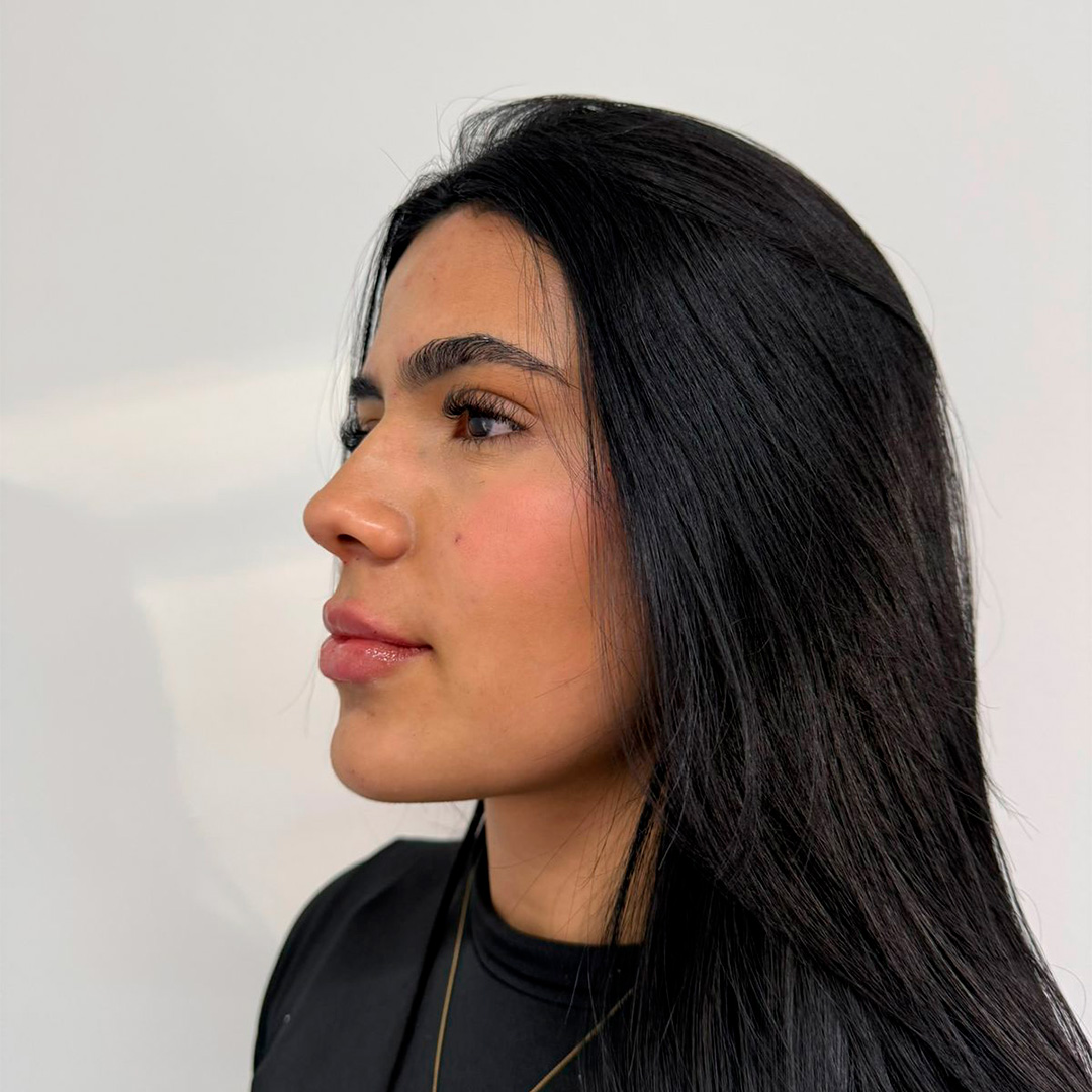 Mulher de perfil mostrando a boca depois do procedimento em clinica de estetica