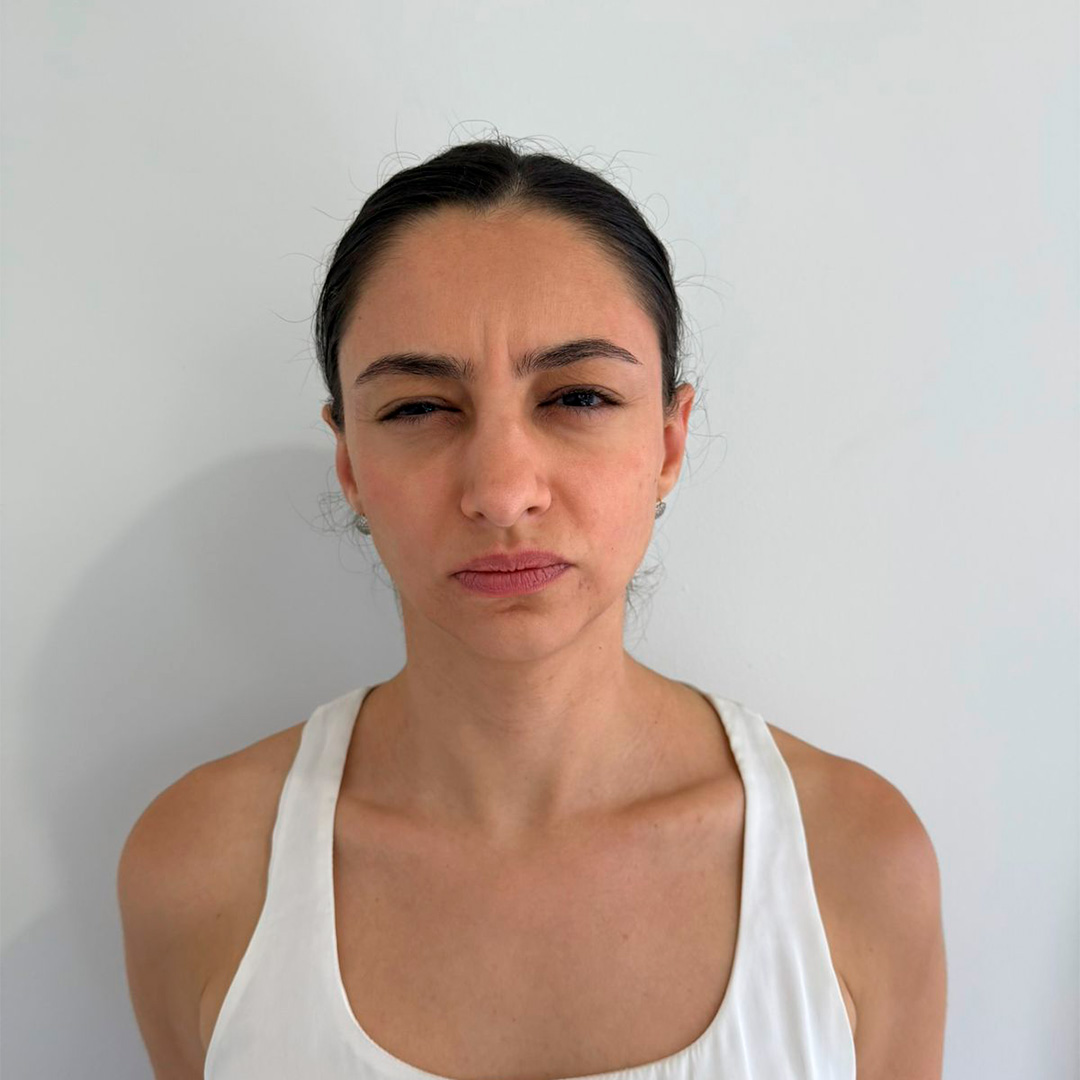 Mulher branca de cabelos pretos franzindo a testa depois de procedimento em clinica de estetica