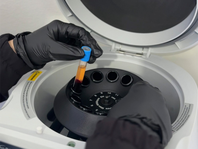 Maquina de PRP em funcionamento para procedimentos esteticos