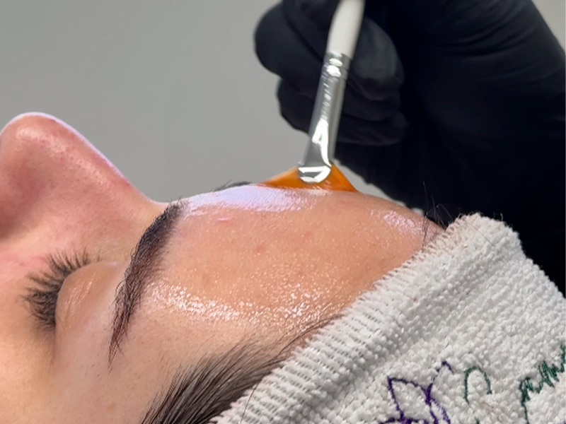 Procedimento de peeling sendo realizado na testa de cliente