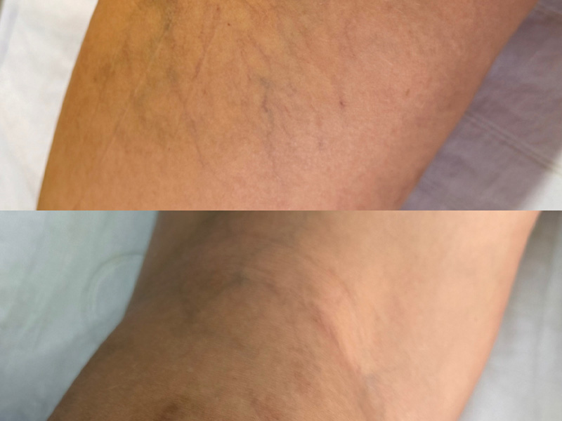 Imagens comparativas de antes de depois do procedimento estetico de Secagem de vasinhos